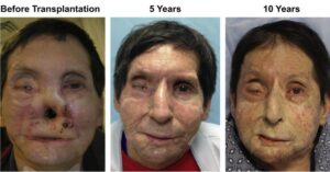 Read more about the article Face Transplant Surgery: Recovery, Rehabilitation, and Long-Term Care